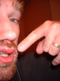 bruisedlip2.jpg bruisedlip2.jpg